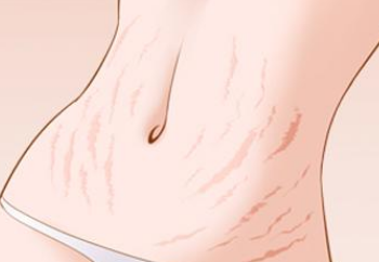 妊娠纹什么时候出现,要怎么去避免?(图1) 母乳分析仪